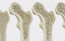 Bone Deep: All About Osteoporosis