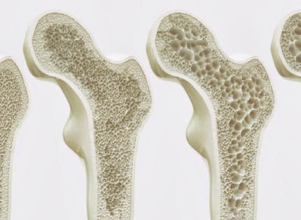 Bone Deep: All About Osteoporosis