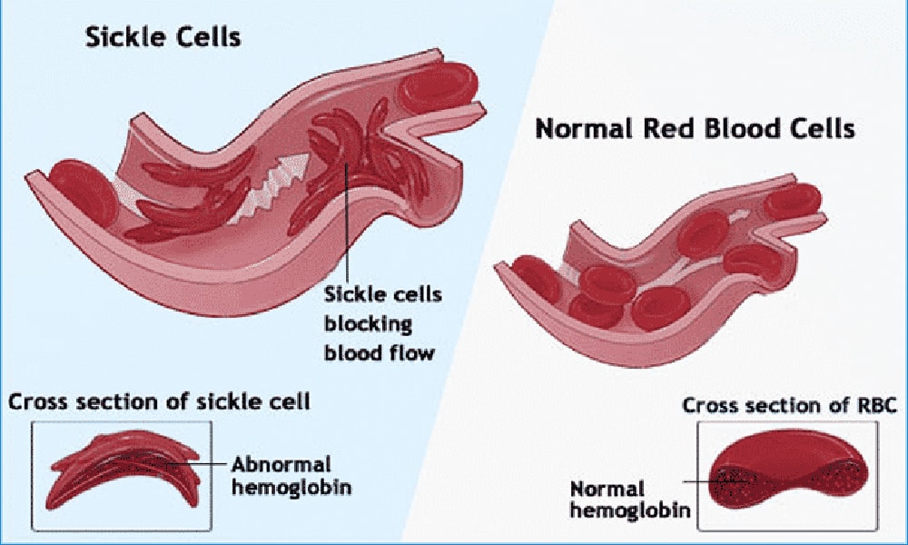 Sickle Cell Awareness Month: Are You Aware?