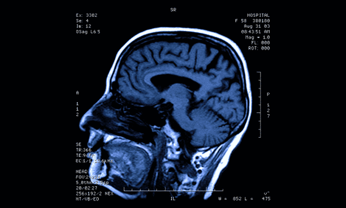 brain scan CT