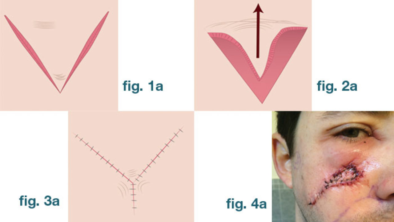 The V Y Island Advancement Flap Reconstruction Chicago Health