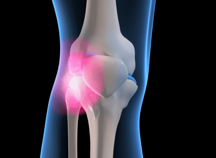 Noninvasive Procedure Alternative to Knee Replacement Surgery