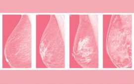 Getting smart about dense breast tissue