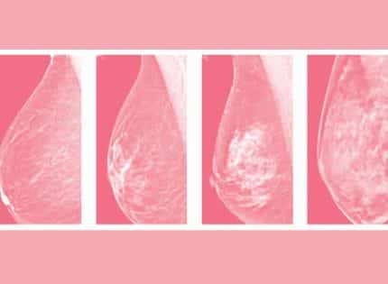 Getting smart about dense breast tissue