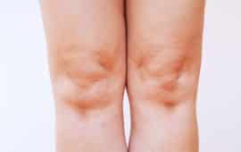 Leg swelling often caused by vein problems