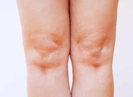 Leg swelling often caused by vein problems