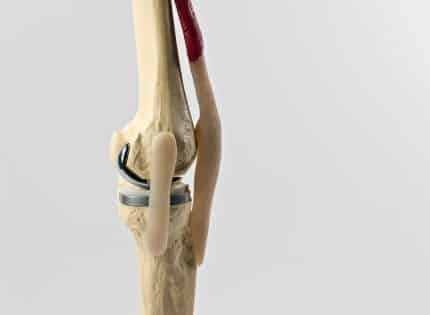 When is it time for knee replacement?