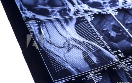 Knee damage appearing on MRI predicts arthritis ahead