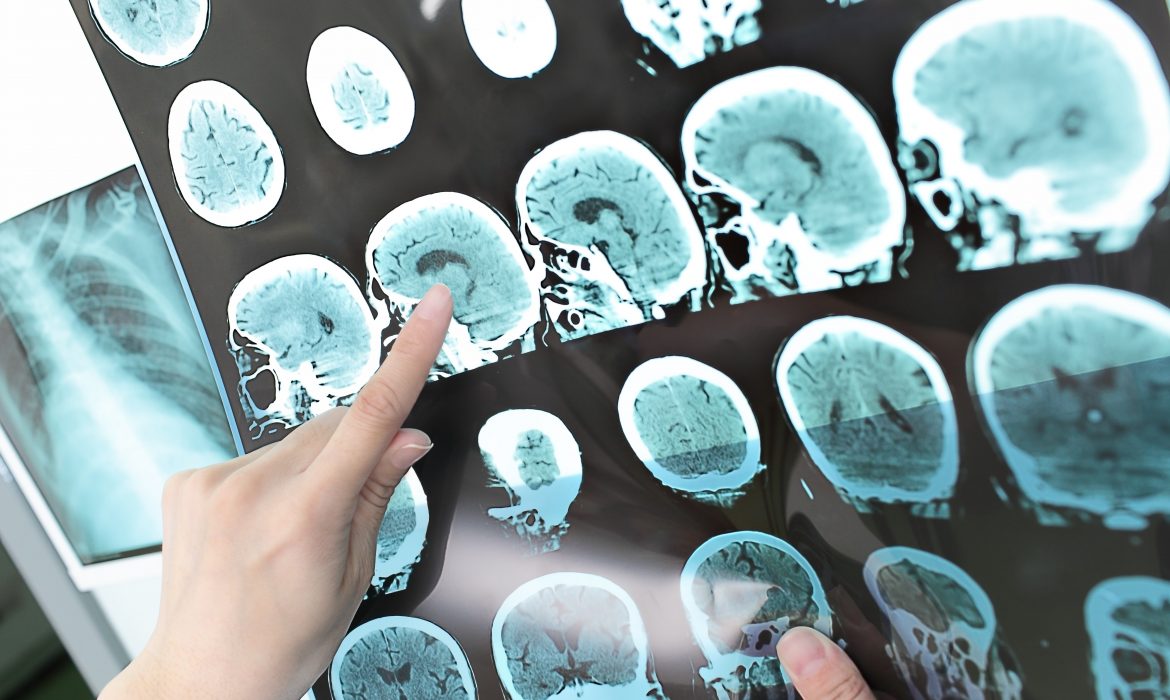 Evaluation after stroke can help identify common causes