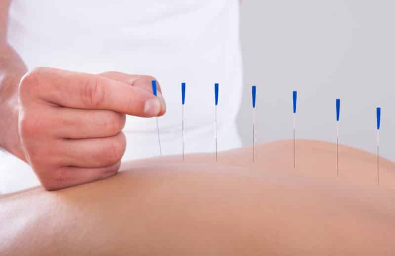 Acupuncture practitioner performing acupuncture on an individual's back