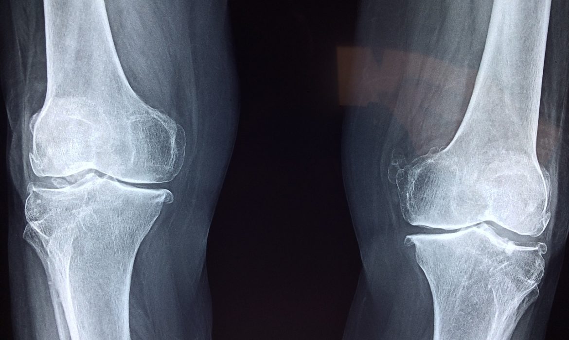 The mysterious rise in knee osteoarthritis