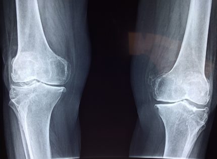 The mysterious rise in knee osteoarthritis