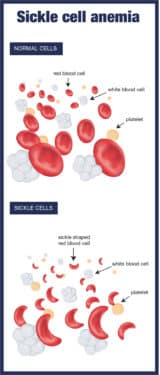 Sickle cell disease illustration