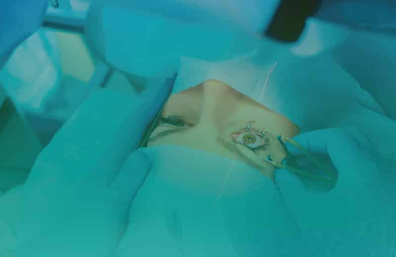 Lasik surgery