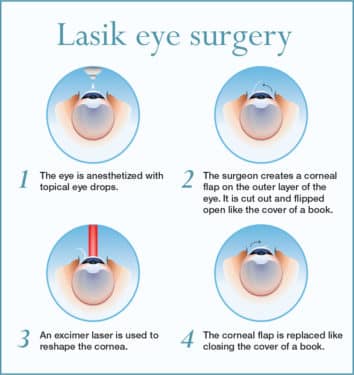 Lasik surgery infographic