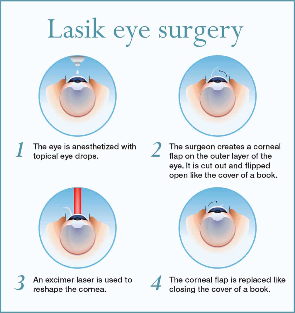 All Eyes on Lasik - Chicago Health | CHicago Health magazine