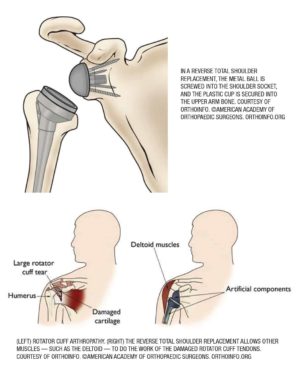 Reverse total shoulder replacement illustration