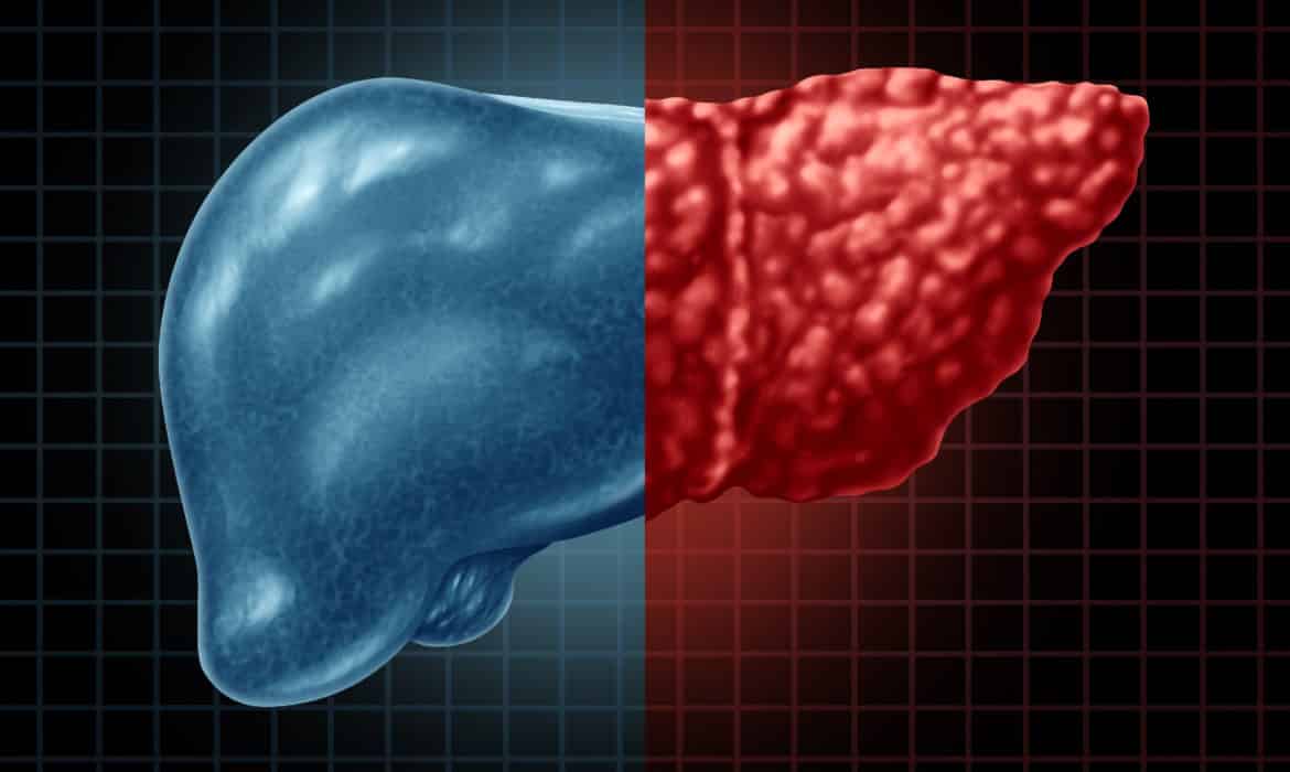 Weight Loss Can Help Head Off Lasting Damage Caused by Fatty Liver