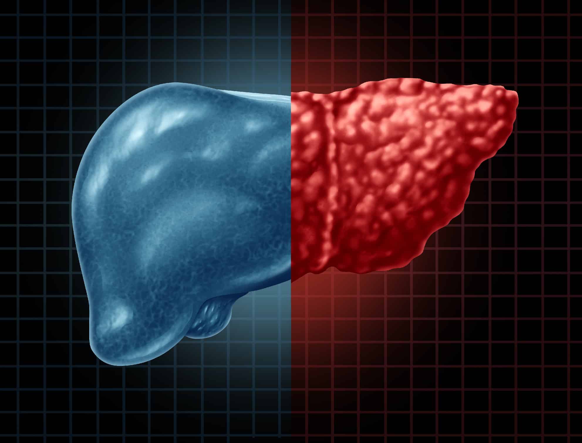 Weight Loss Can Help Head Off Lasting Damage Caused By Fatty Liver