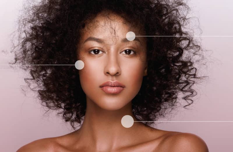 African American woman with areas of her skin circled. This highlights the lack of representation in the field of dermatology for people of color.