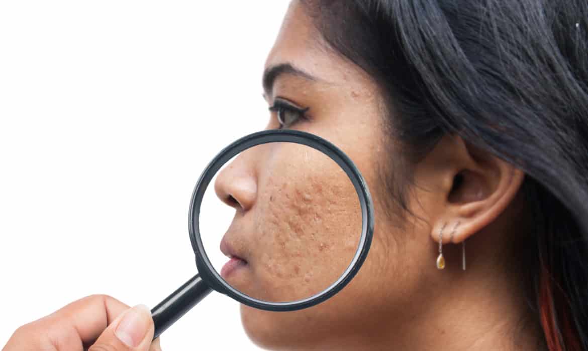 Does Diet Really Matter When It Comes to Adult Acne?