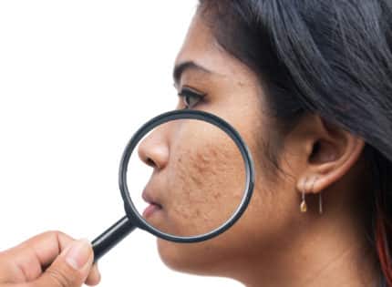 Does Diet Really Matter When It Comes to Adult Acne?