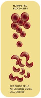 Sickle Cell Disease illustration