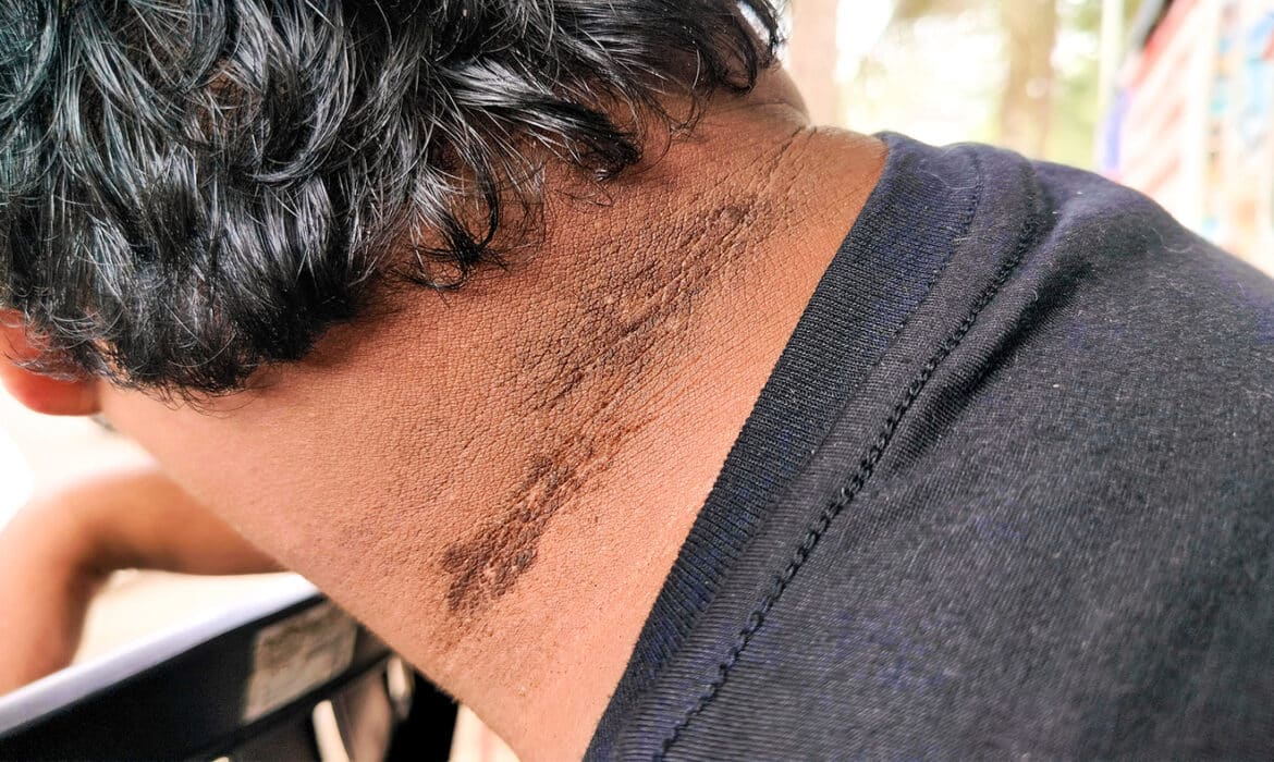 Image of a man with a rash on his neck. Skin conditions, Acanthosis Nigricans