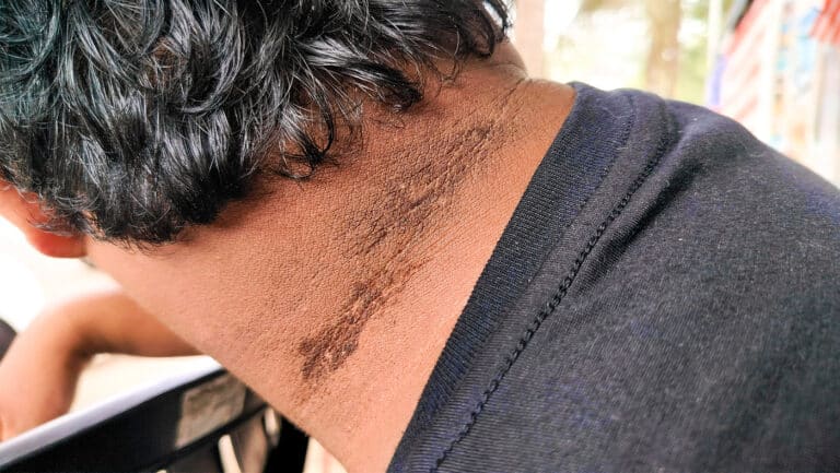 Image of a man with a rash on his neck. Skin conditions, Acanthosis Nigricans