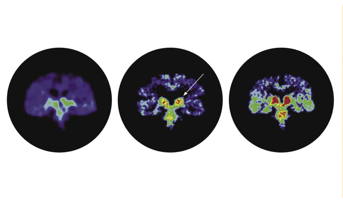 PET scan showing traumatic brain injury