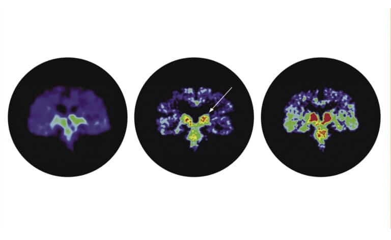 PET scan showing traumatic brain injury