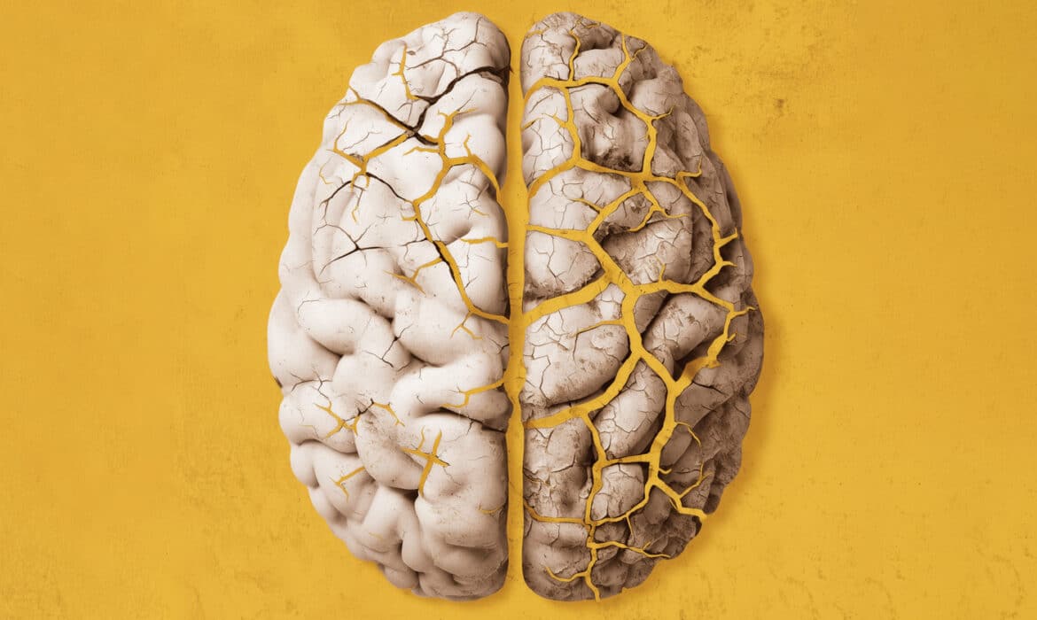 Representational illustration of an eroding brain representing Parkinson's Disease