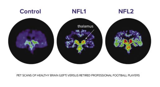 PET scan of brain injury with caption